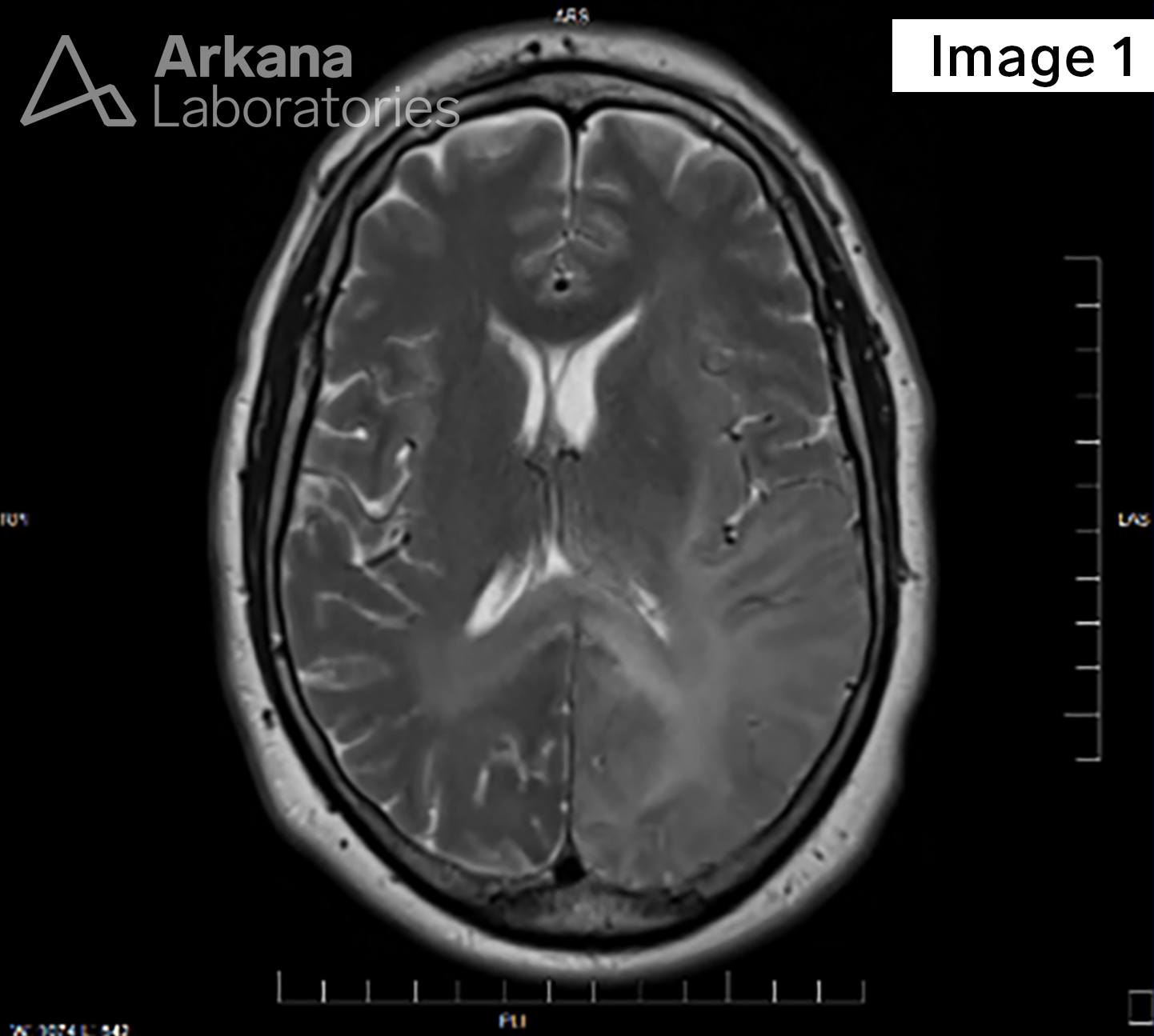 brain biopsy, Diffuse Astrocytoma IDH-Mutant, neuro notes, neuropathology