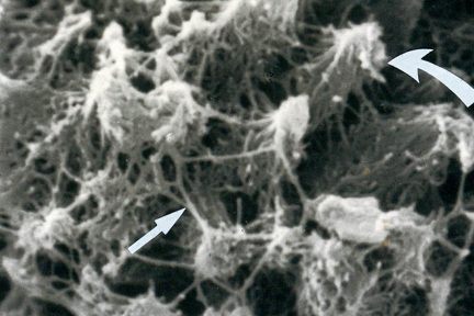 spicular amyloid with tapering conical masses, interconnected by branching fibrils, eyescandy, stephen bonsib, arkana laboratories