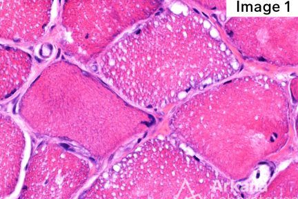 Lipid Storage Myopathy, Arkana Laboratories, neuro notes, neuropathology, molecular pathology