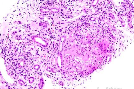 Sarcoidosis, kidney biopsy stain, arkana laboratories, renal pathology