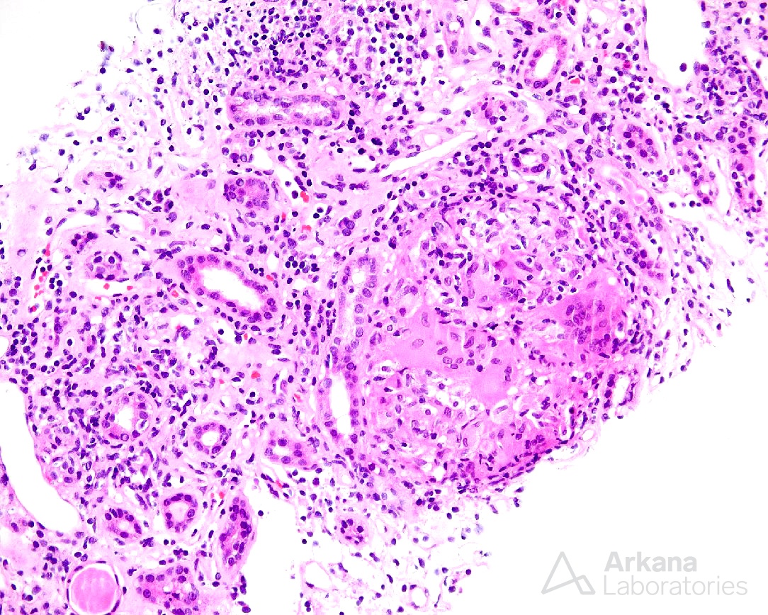 Sarcoidosis, kidney biopsy stain, arkana laboratories, renal pathology