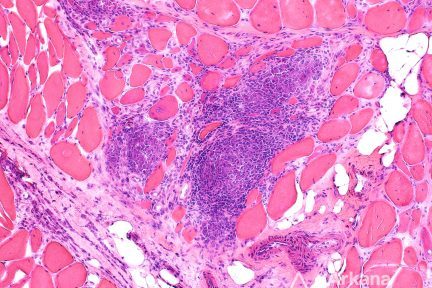 sarcoidosis, neuro notes, arkana laboratories