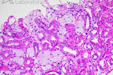 Alport Syndrome, Arkana Laboratories, diagnose this, renal pathology, kindey path, kidney disease