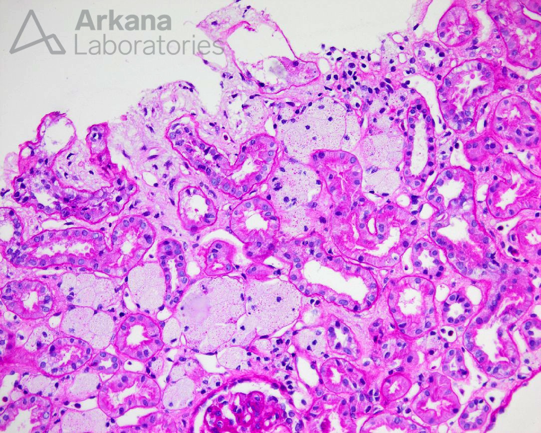 Alport Syndrome, Arkana Laboratories, diagnose this, renal pathology, kindey path, kidney disease