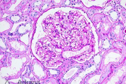 glomerulomegaly, arkana laboratories, renal pathology, diagnose this, kidney pathology