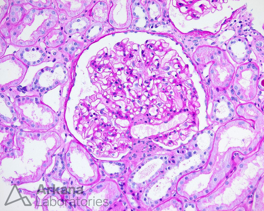 glomerulomegaly, arkana laboratories, renal pathology, diagnose this, kidney pathology