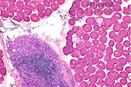 Macrophagic Myofasciitis (MMF), neuro notes, arkana laboratories, neuropathology