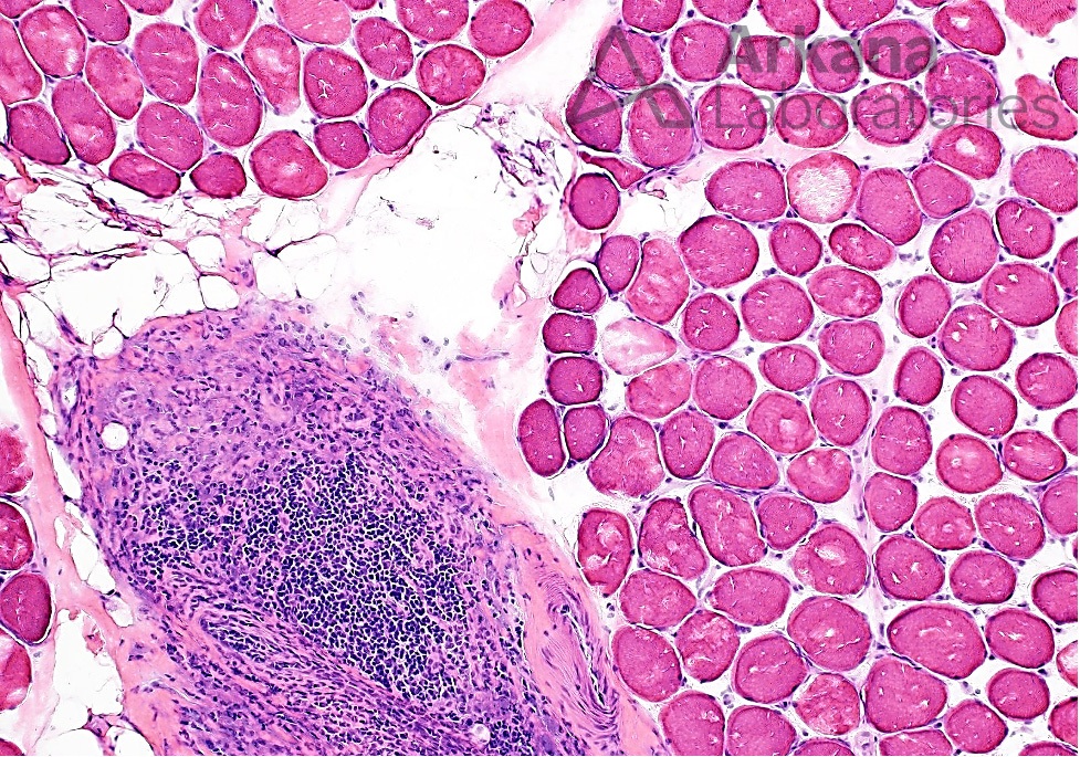 Macrophagic Myofasciitis (MMF), neuro notes, arkana laboratories, neuropathology