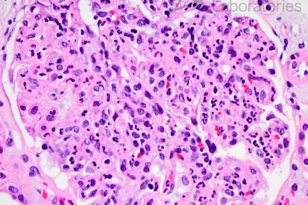 C3-dominant immune-complex, neutrophilic endocapillary hypercellularity, diagnose this, renal pathology, kidney biopsy, arkana laboratories