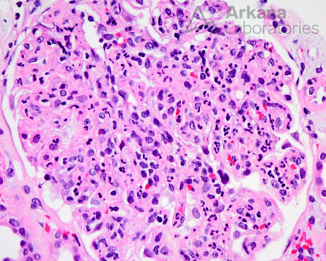 C3-dominant immune-complex, neutrophilic endocapillary hypercellularity, diagnose this, renal pathology, kidney biopsy, arkana laboratories