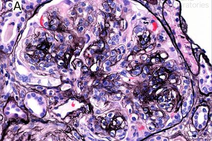 Monoclonal IgG Deposits