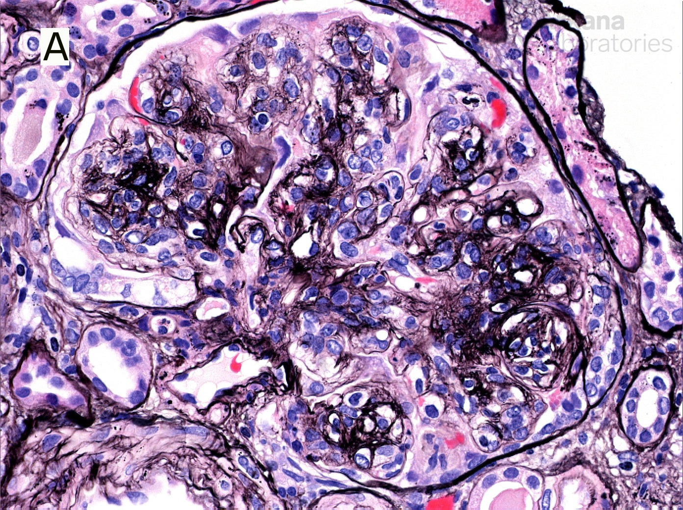 Monoclonal IgG Deposits