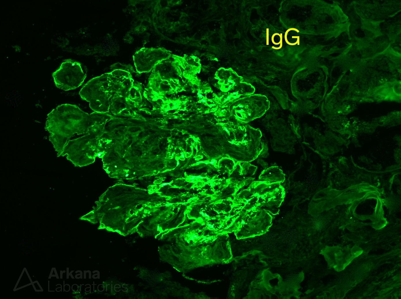 Monoclonal IgG Deposits