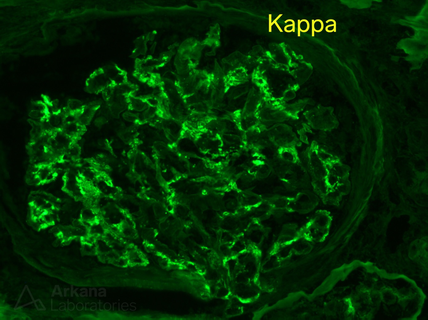 Monoclonal IgG Deposits