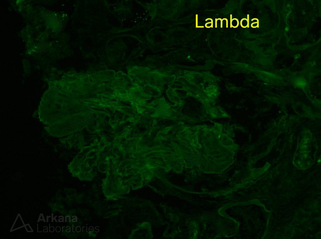 Lambda stain in renal biopsy