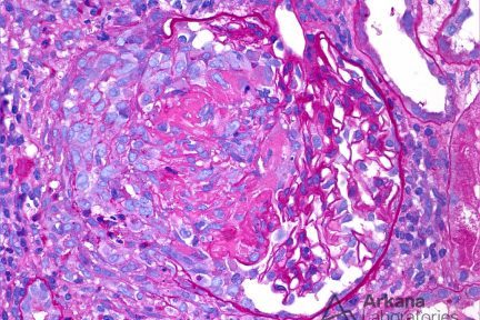 endocarditis associated glomerulonephritis