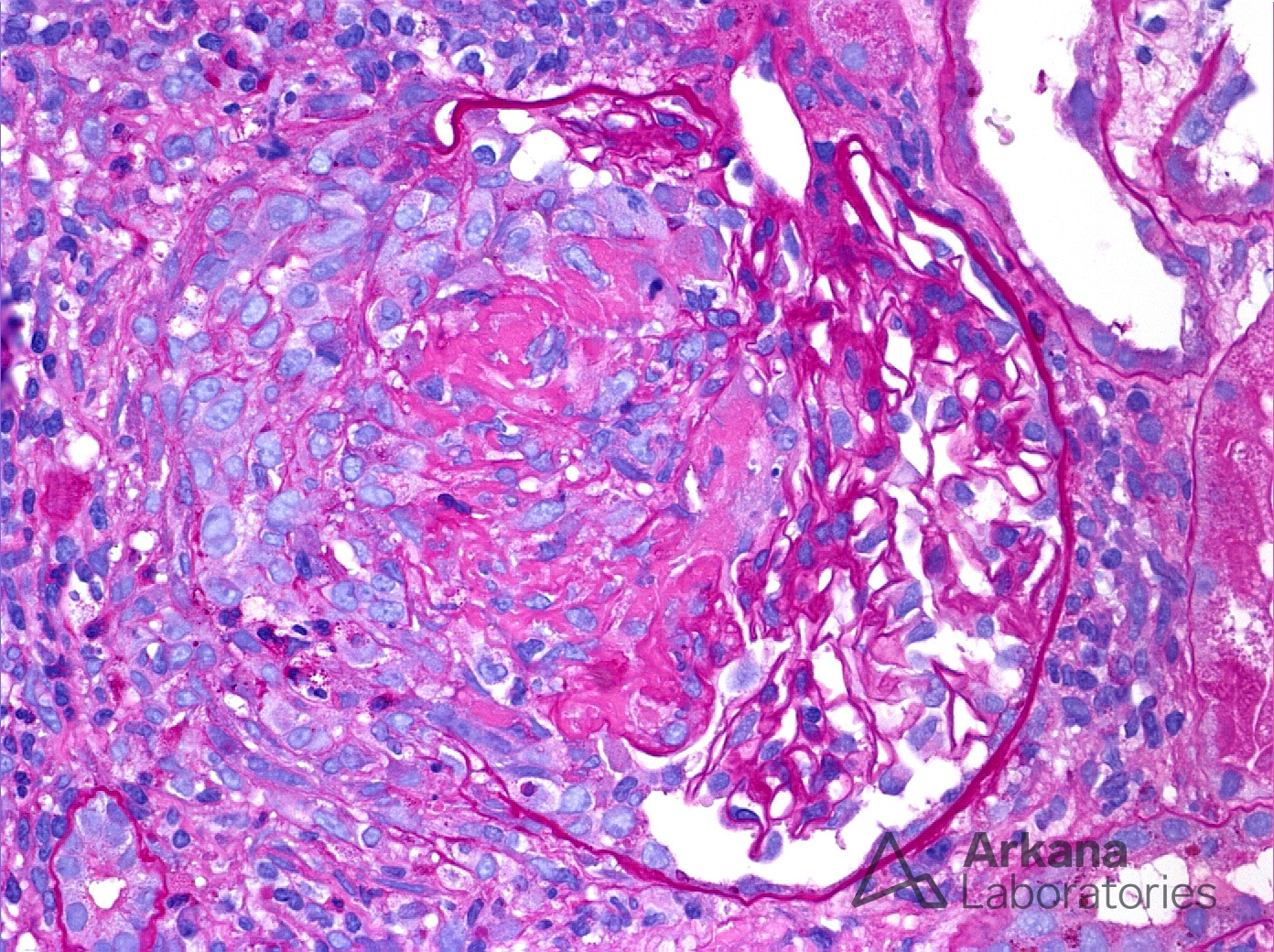 endocarditis associated glomerulonephritis