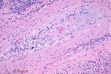 Cryoglobulinemic Intimal Arteritis