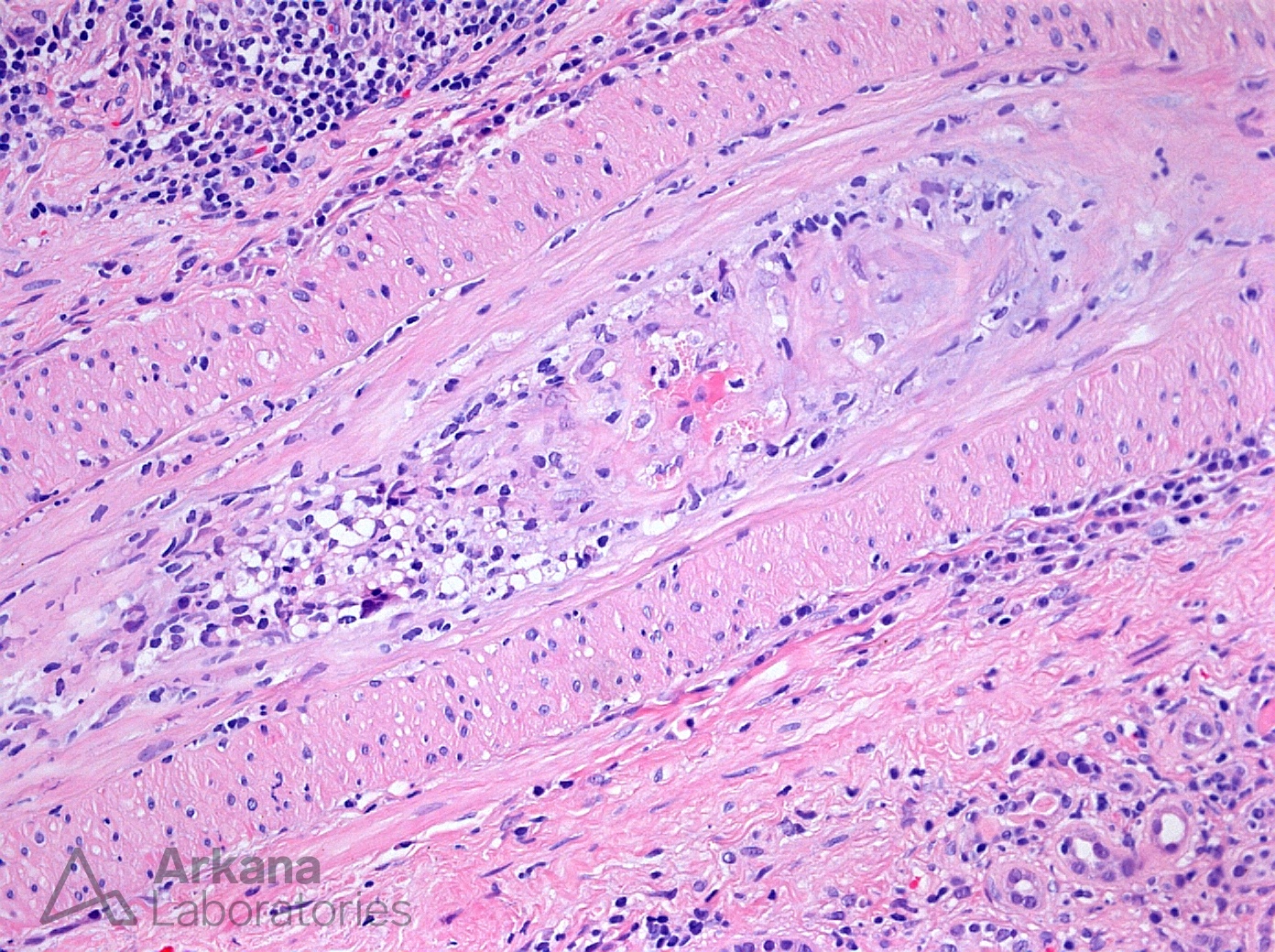 Cryoglobulinemic Intimal Arteritis