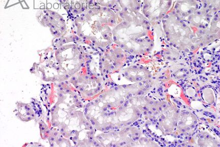 Amyloidosis, LECT-2, renal pathology, kidney biopsy, arkana laboratories