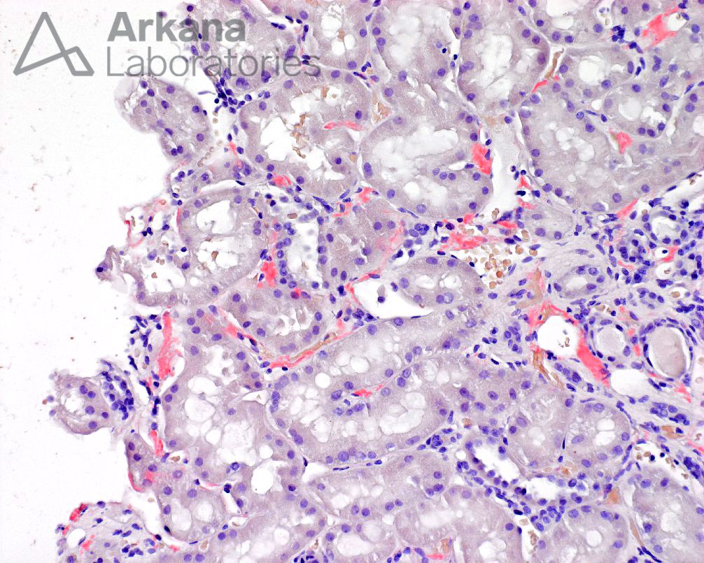 Amyloidosis, LECT-2, renal pathology, kidney biopsy, arkana laboratories