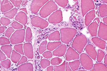 grouped atrophy, neuro notes, neuropathology