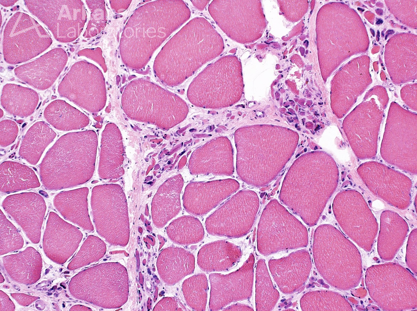 grouped atrophy, neuro notes, neuropathology