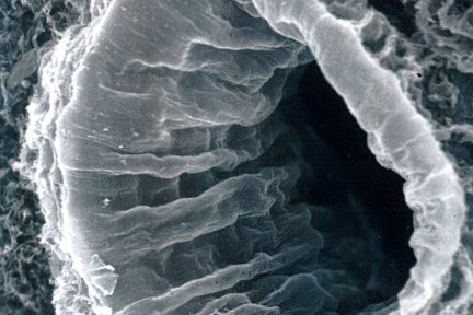 Corrugated Lumen of a Renal Artery, bonsib, renal pathology, eyescandy, arkana laboratories