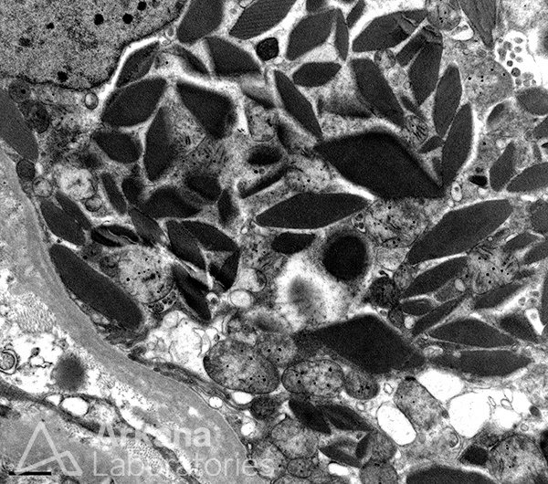 light chain proximal tubulopathy, diagnose this, Dr. Joel Murphy, renal pathology, arkana laboratories