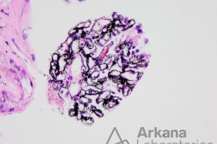 renal argyria, arkana laboratories, renal pathology, kidney