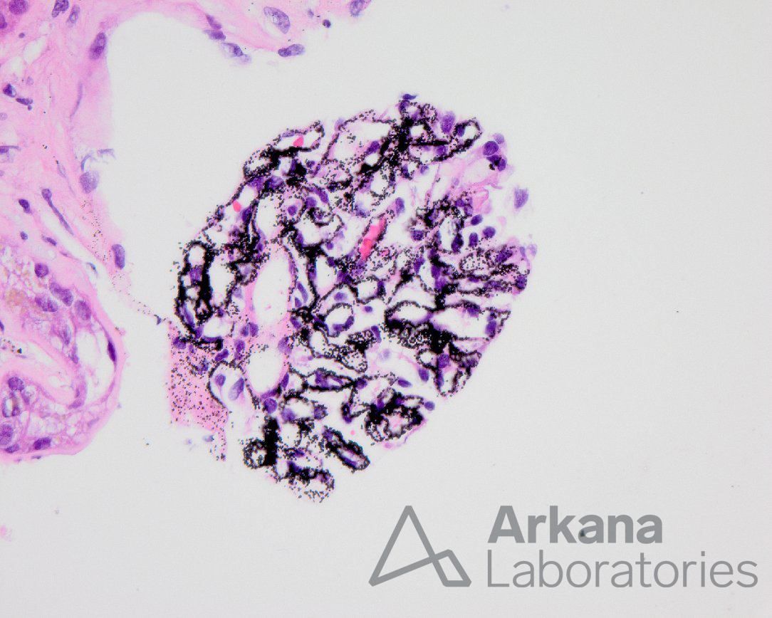 renal argyria, arkana laboratories, renal pathology, kidney