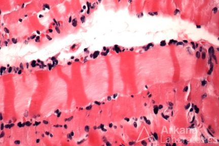Contraction Band Artifact , Neuro Notes, neuropathology