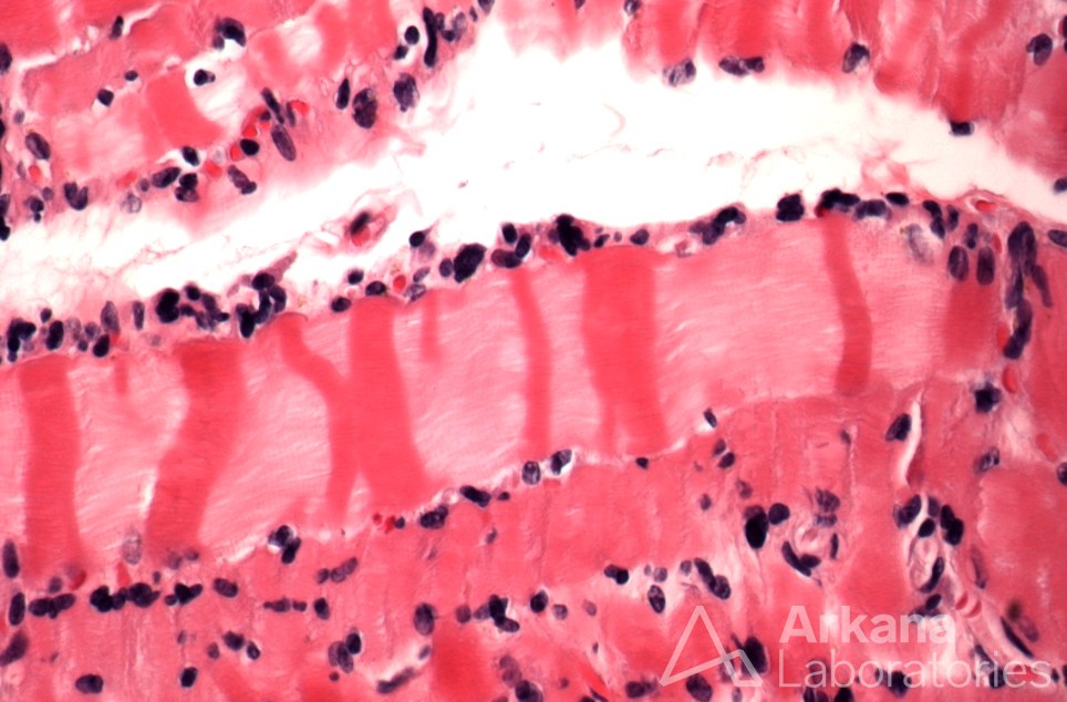 Contraction Band Artifact , Neuro Notes, neuropathology