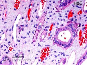 Randall’s plaques shown in renal biopsy