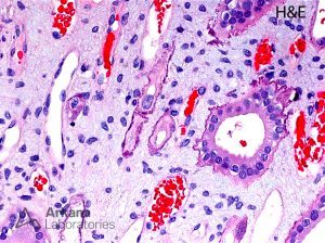 Randall’s plaques shown in renal biopsy