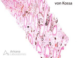positive Von Kossa stain in renal cortex