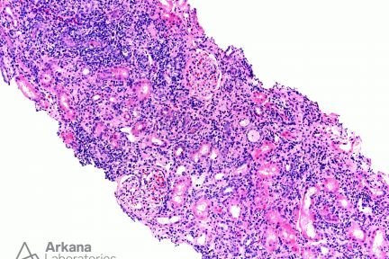 (CIN) Chronic Interstitial Nephritis