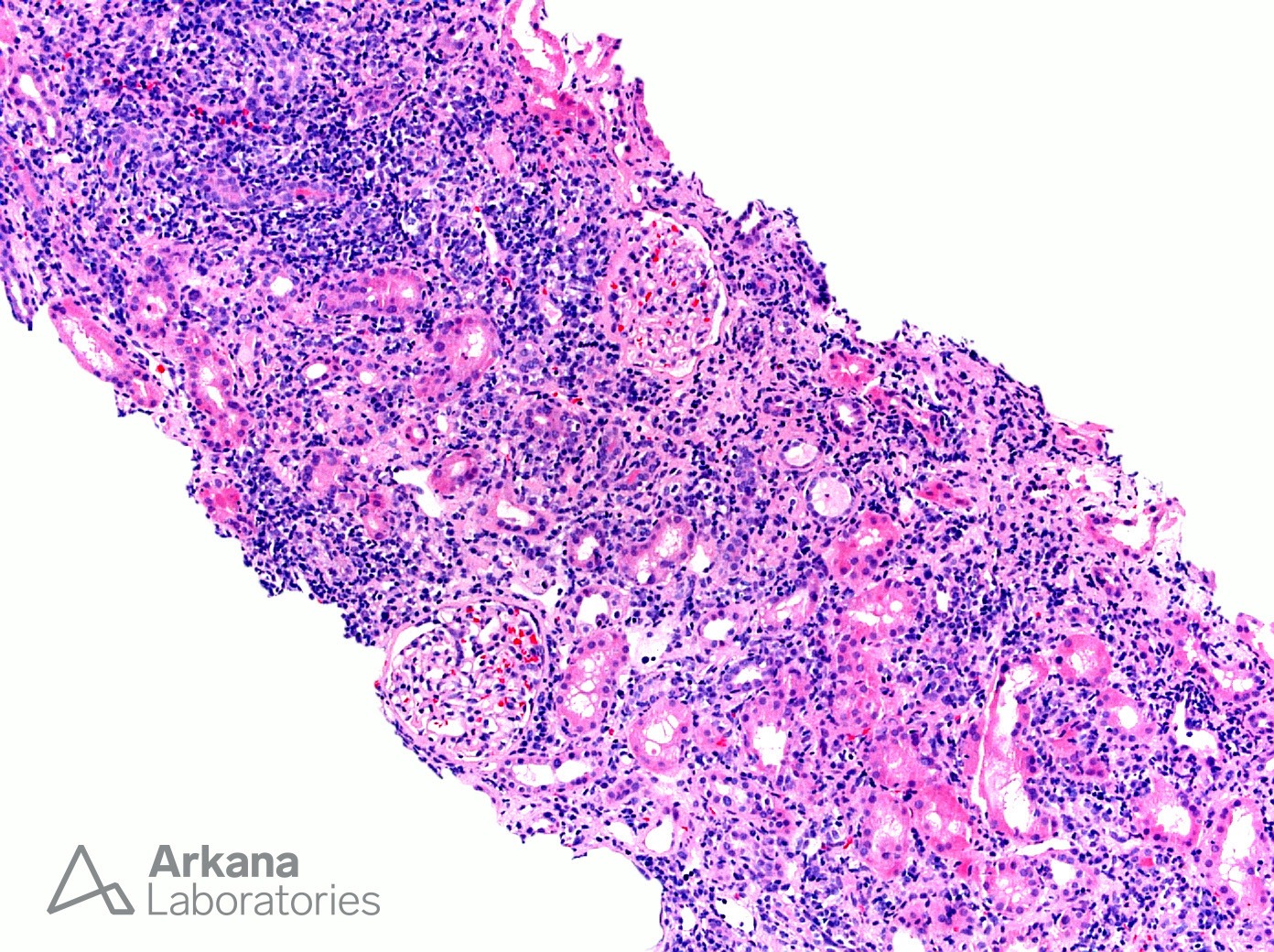 (CIN) Chronic Interstitial Nephritis