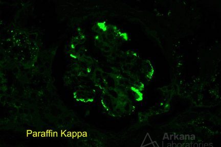 Monoclonal Gammopathy