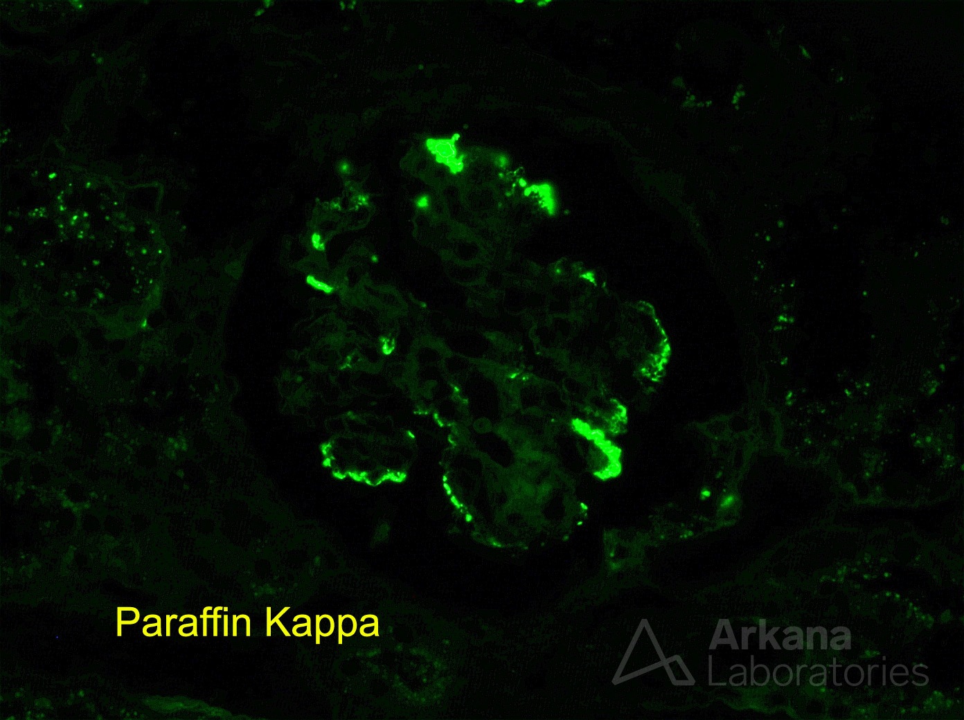 Monoclonal Gammopathy