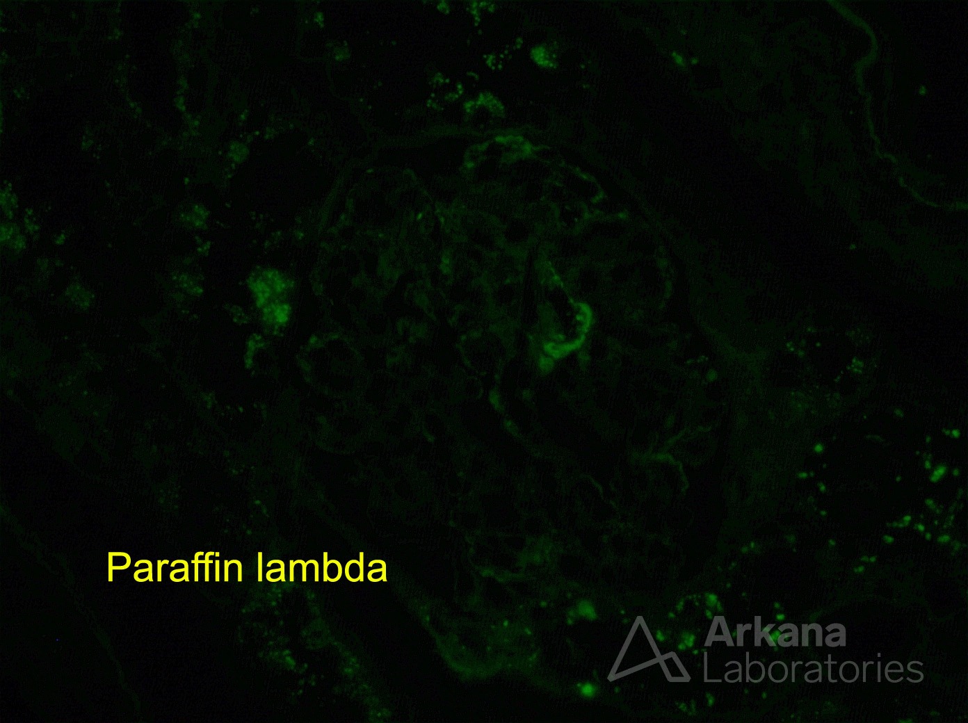 paraffin lambda renal biopsy stain, Monoclonal gammopathy of renal significance