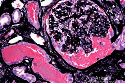 warfarin-related nephropathy