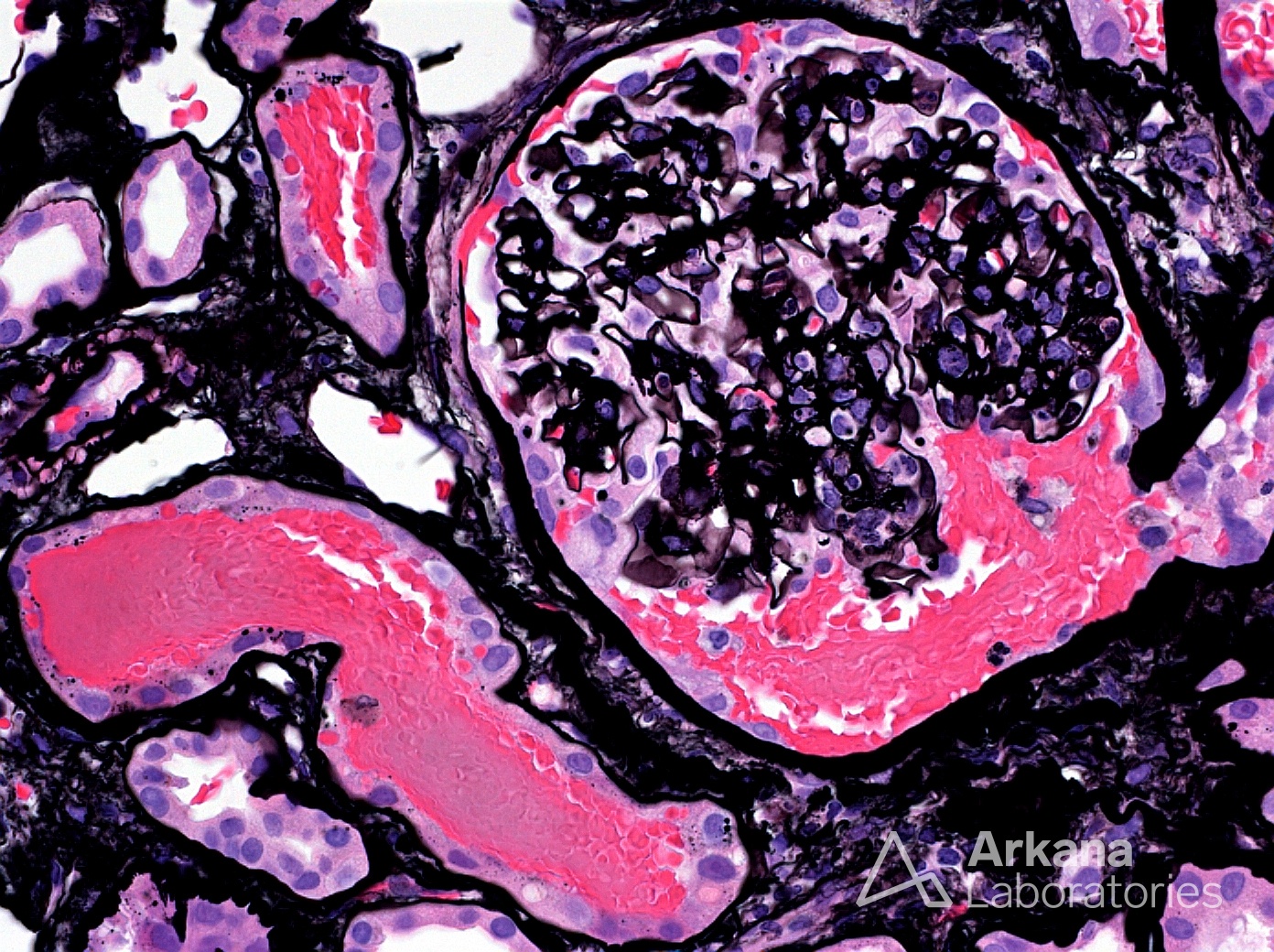 warfarin-related nephropathy