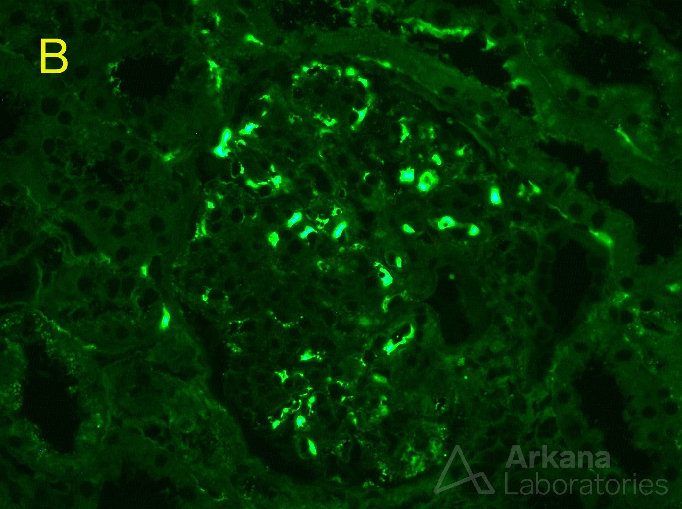 IgA staining is strongly positive only within the capillary spaces of a glomerulus by paraffin immunofluorescence
