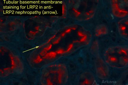 Anti-LPR2 Nephropathy