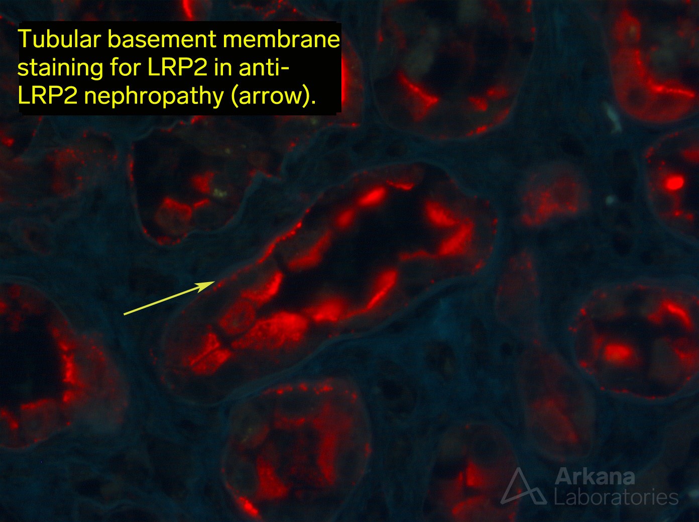 Anti-LPR2 Nephropathy