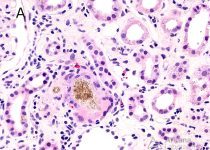 2,8 DHA Crystalline Nephropathy