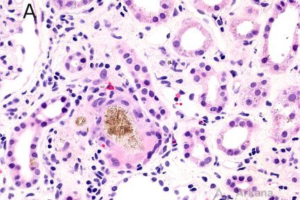 2,8 DHA Crystalline Nephropathy