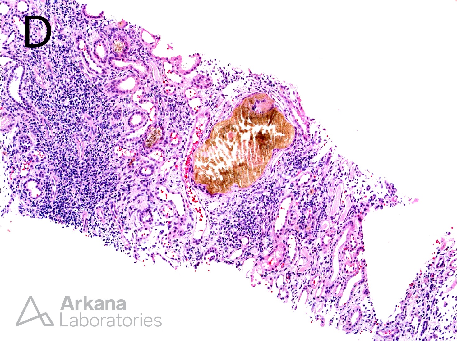 Small needle-shaped brownish crystals are present within the tubular lumens and epithelial cells