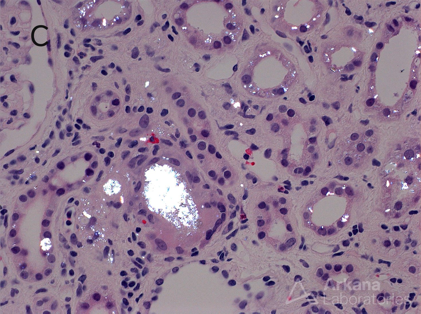 2,8 DHA Crystalline Nephropathy